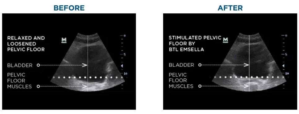 EMSELLA Jacksonville FL Pelvic Floor Before and After